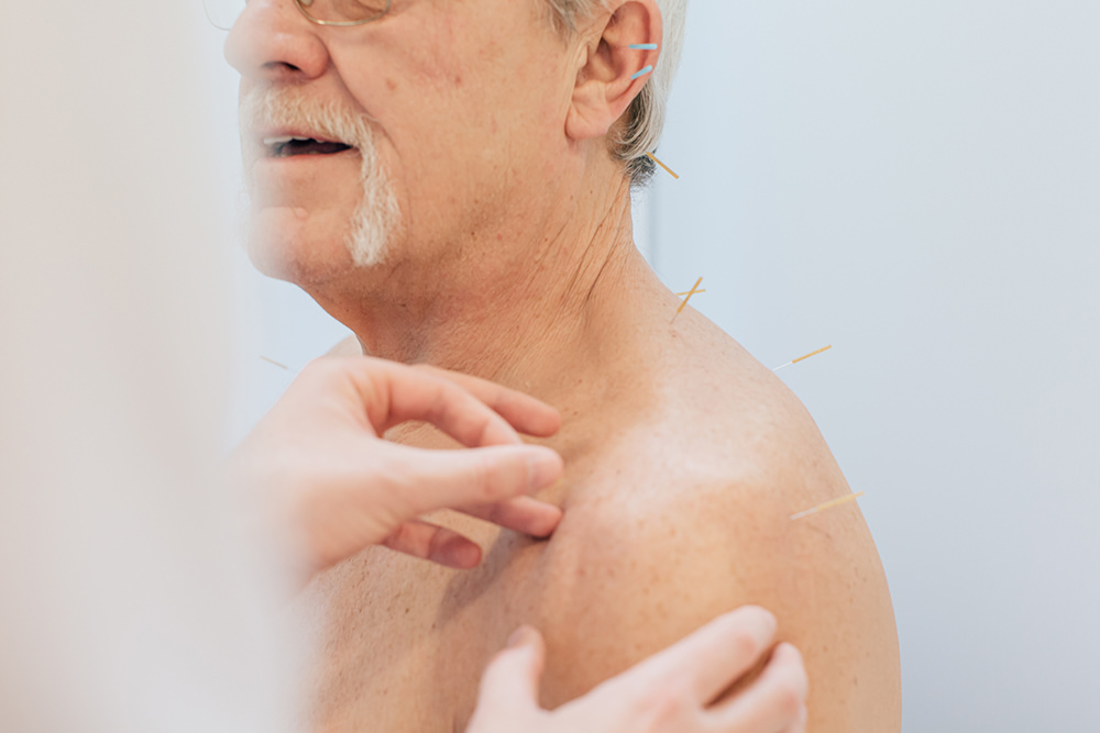 Akupunktur Bensberg - Reitenbach - Nadeln im Rücken von männlichem patienten